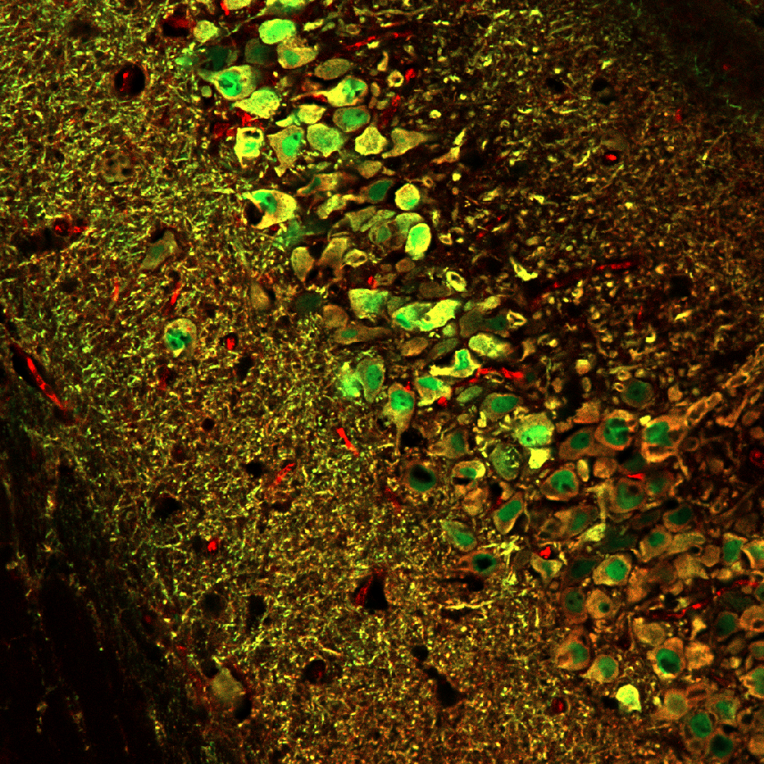 Tau-Pathologie in Nervenzellen des Hippokampus